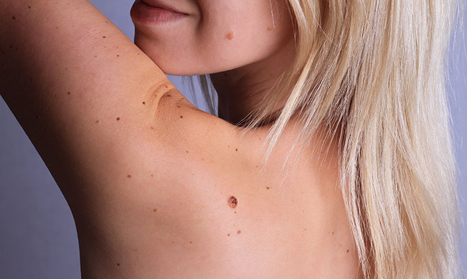 Skin Cancer Moles and how to detect them