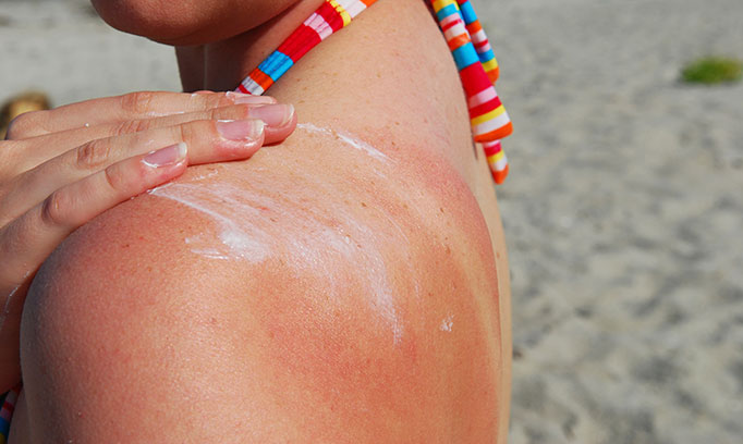 Instant Sunburn Relief & Cure, Cure a Sunburn