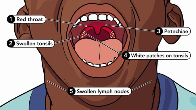 strep throat symptoms