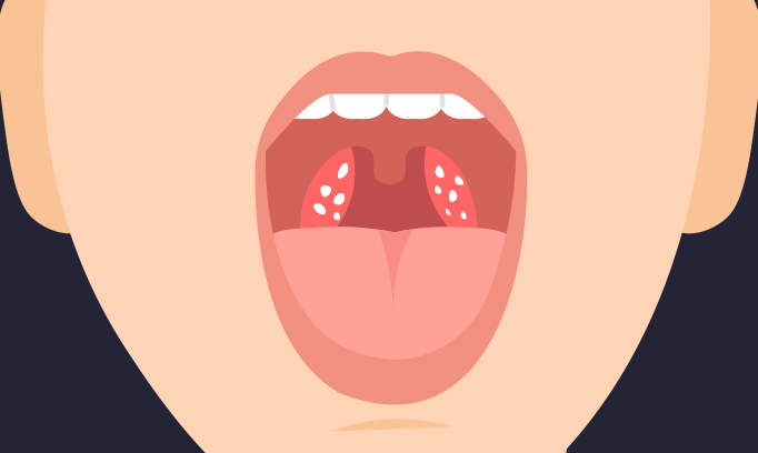 Tonsil Stones | Symptoms, Causes And Removal | Allina Health